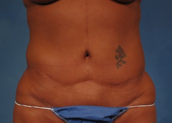 53 year old Female who underwent Tummy Tuck Revision to improve appearance of prior surgery before 1194112