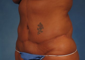 53 year old Female who underwent Tummy Tuck Revision to improve appearance of prior surgery 1194112