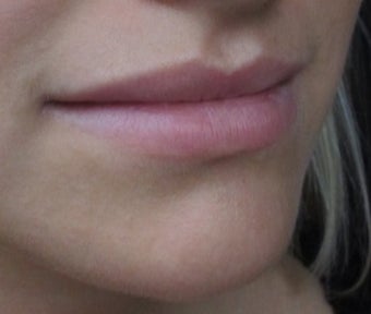 18-24 year old woman treated with Lip Augmentation before 2847445