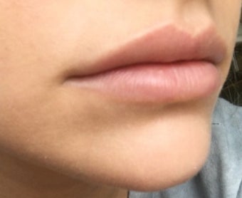 18-24 year old woman treated with Lip Augmentation after 2847445