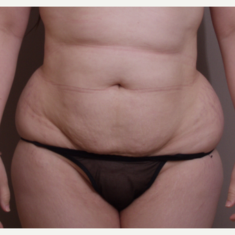 35-44 year old woman treated with Tummy Tuck before 3093307