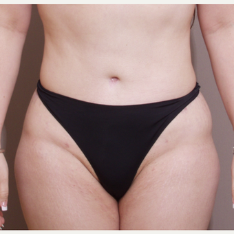 35-44 year old woman treated with Tummy Tuck after 3093307