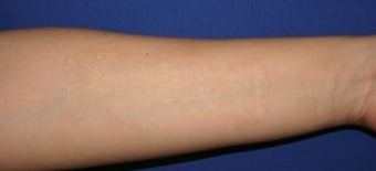 Self-harm scars. Before and after "dermabrasion and thin skin grafting". after 1359014