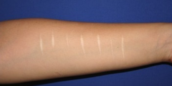Self-harm scars. Before and after "dermabrasion and thin skin grafting". before 1359014