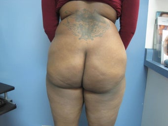 36 year old woman treated with Brazilian Butt Lift before 2672052