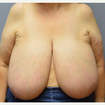 55-64 year old woman treated with Breast Reduction before 3369986