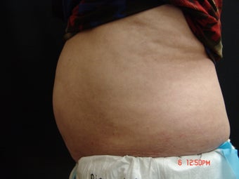 Coolsculpting before 417588