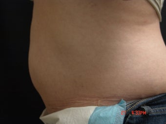 Coolsculpting after 417588