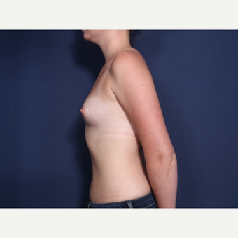 25-34 year old woman treated with Breast Augmentation (view 2 of 2) before 3103339