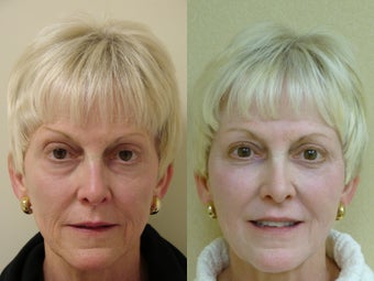 55 year old female treated for volume loss of the face with fat transfer (grafts) before 918798