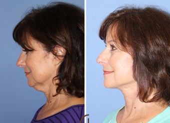 55-64 year old woman treated with Neck Lift before 2990697
