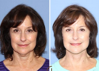 55-64 year old woman treated with Neck Lift after 2990697