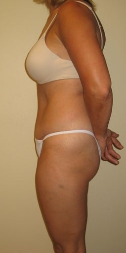 37 year old seeks Tummy Tuck 1325353