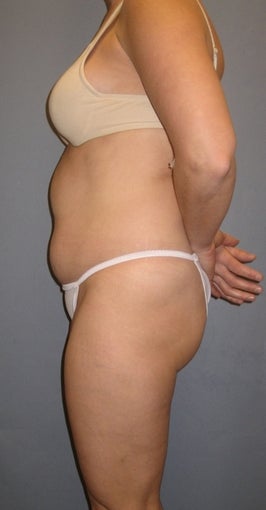 37 year old seeks Tummy Tuck 1325353