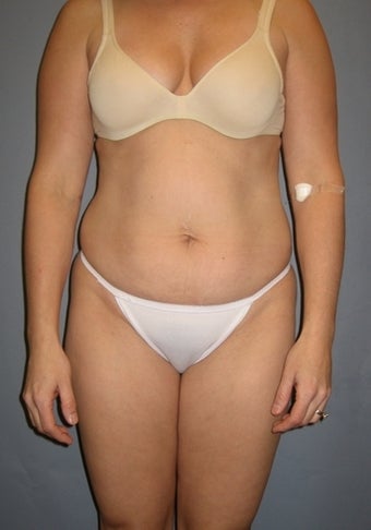 37 year old seeks Tummy Tuck before 1325353