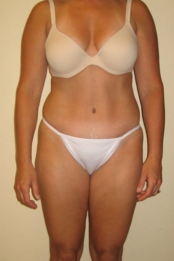 37 year old seeks Tummy Tuck after 1325353