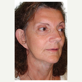 52 year old woman treated with Facelift after 3548838
