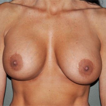 45-54 year old woman treated with Breast Implants after 3173426