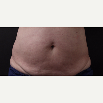 59 year old woman treated with CoolSculpting before 3384608