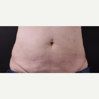 59 year old woman treated with CoolSculpting after 3384608
