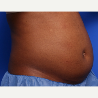 25-34 year old woman treated with CoolSculpting before 2253666