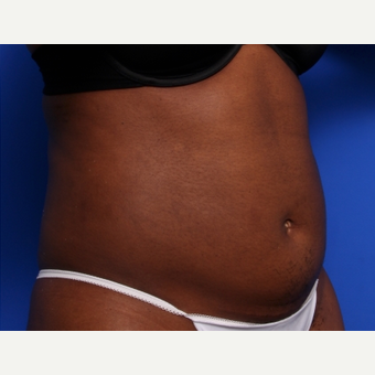 25-34 year old woman treated with CoolSculpting after 2253666