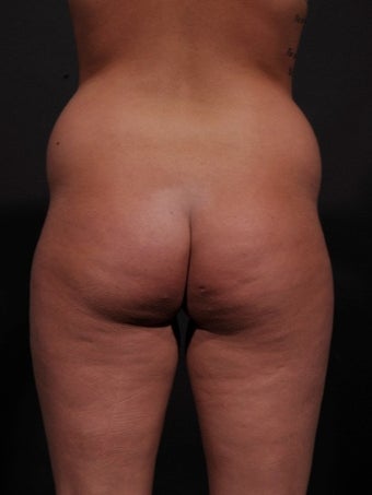 18-24 year old woman treated for Liposuction 1534676