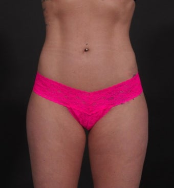 18-24 year old woman treated for Liposuction after 1534676