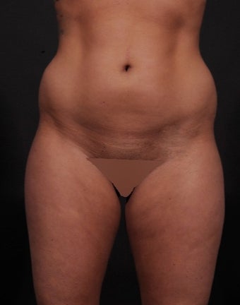 18-24 year old woman treated for Liposuction before 1534676