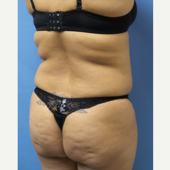 35-44 year old woman treated with Brazilian Butt Lift before 3696170