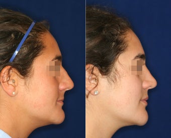 Nose Surgery before 1430592
