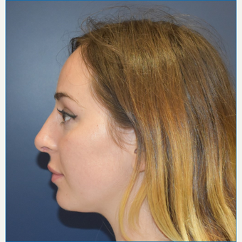 18-24 year old woman treated with Nose Surgery after 3341281
