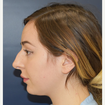 18-24 year old woman treated with Nose Surgery before 3341281