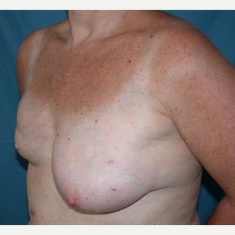 55-64 year old woman treated with Breast Reconstruction 1585131