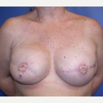 55-64 year old woman treated with Breast Reconstruction after 1585131