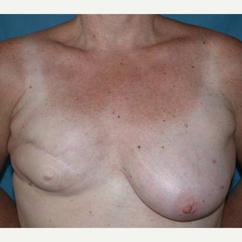55-64 year old woman treated with Breast Reconstruction before 1585131