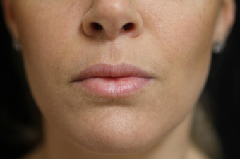 25-34 year old woman treated with Lip Lift before 3577617