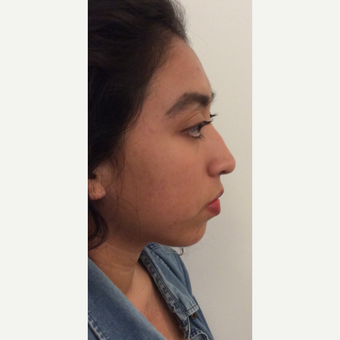 Voluma Non Surgical Nose Job before 3042497