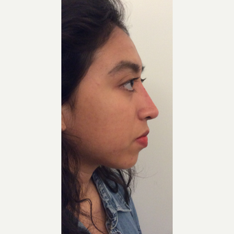 Voluma Non Surgical Nose Job after 3042497