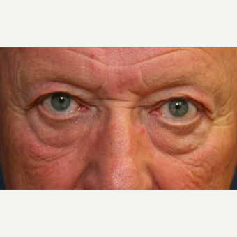 72 year old man with Eyelid Surgery before 3064809