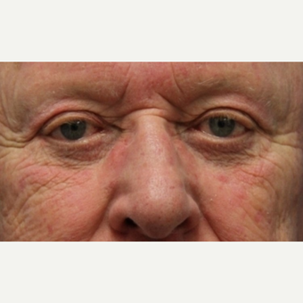 72 year old man with Eyelid Surgery after 3064809