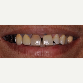 55-64 year old woman treated with Smile Makeover before 3543426