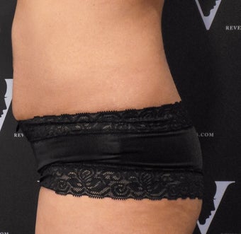 Get rid of the muffin top with CoolSculpting after 3070131