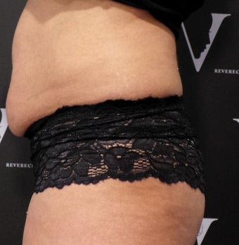 Get rid of the muffin top with CoolSculpting before 3070131