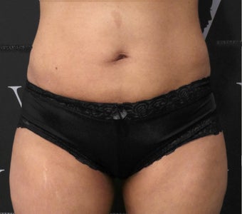 Get rid of the muffin top with CoolSculpting 3070131