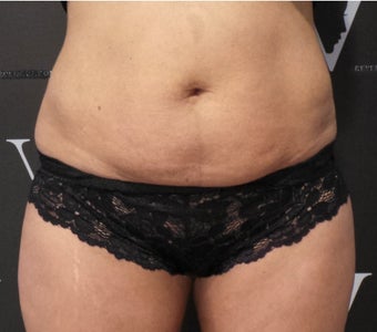 Get rid of the muffin top with CoolSculpting 3070131