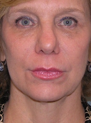55-64 year old woman treated with Chin Liposuction after 2930508