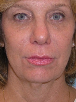55-64 year old woman treated with Chin Liposuction before 2930508