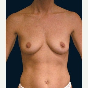 Breast augmentation following pregnancies before 1576870