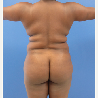 35 y.o. female – Lipo of abdomen, flanks, and back with fat transfer to buttocks – 1300cc per side before 3344826